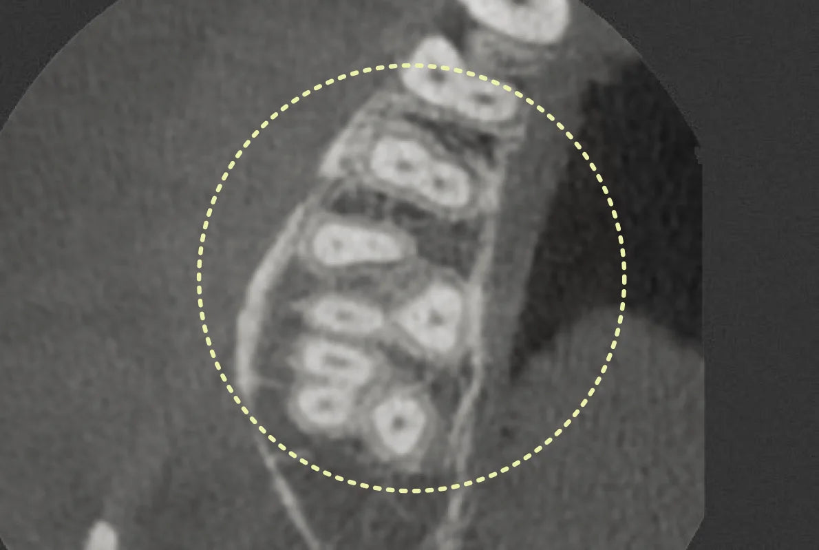 Hiossen T2 Plus AI Implant Planning CBCT - t2-voxel.webp