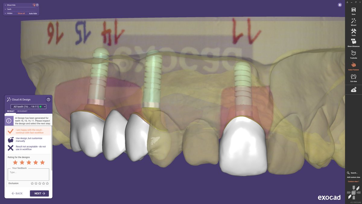 exoplan Implant Planning - Monthly Subscription