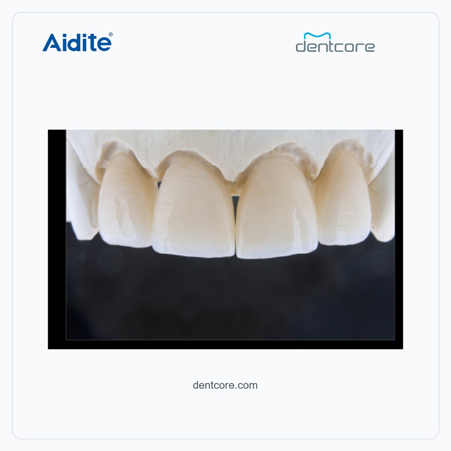 CFP-200 anterior porcelain restoration result