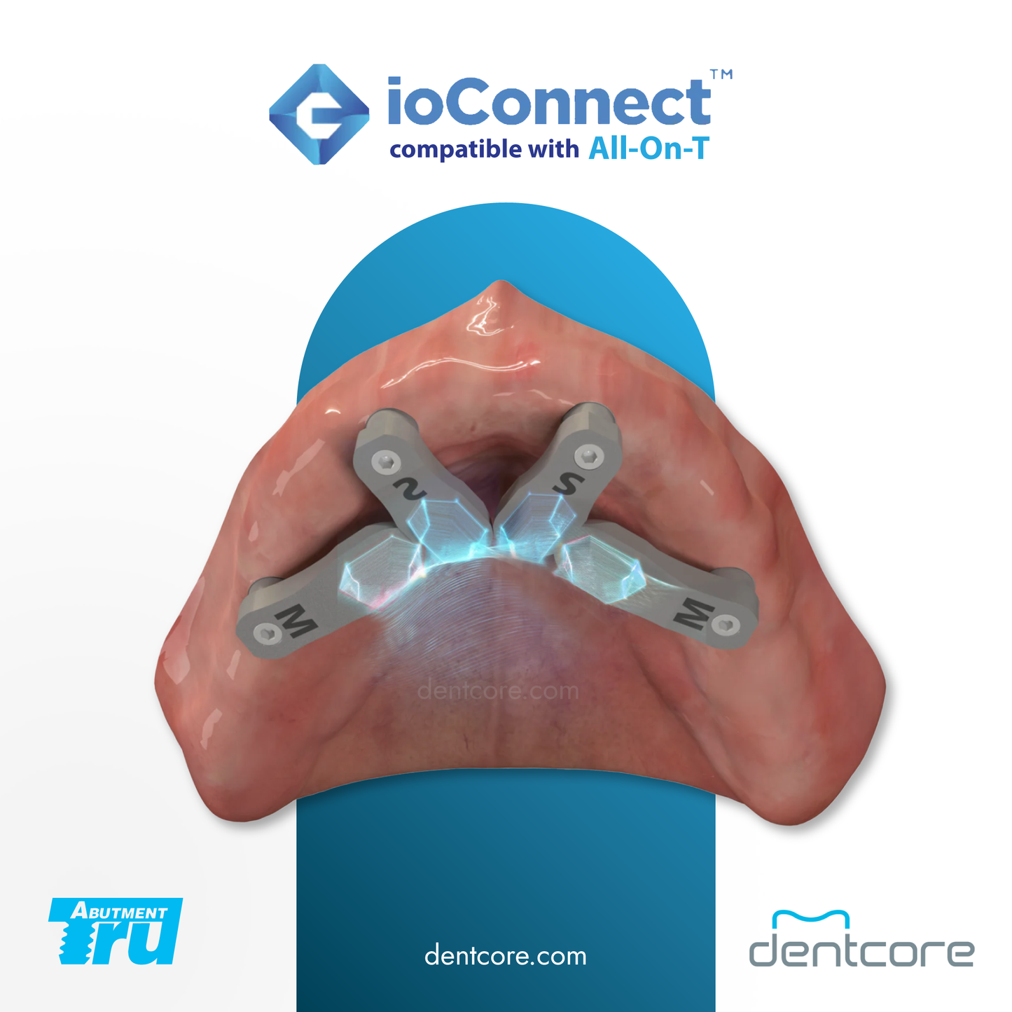 TruAbutment ioConnect All-on-T MUA Compatible Scanbody