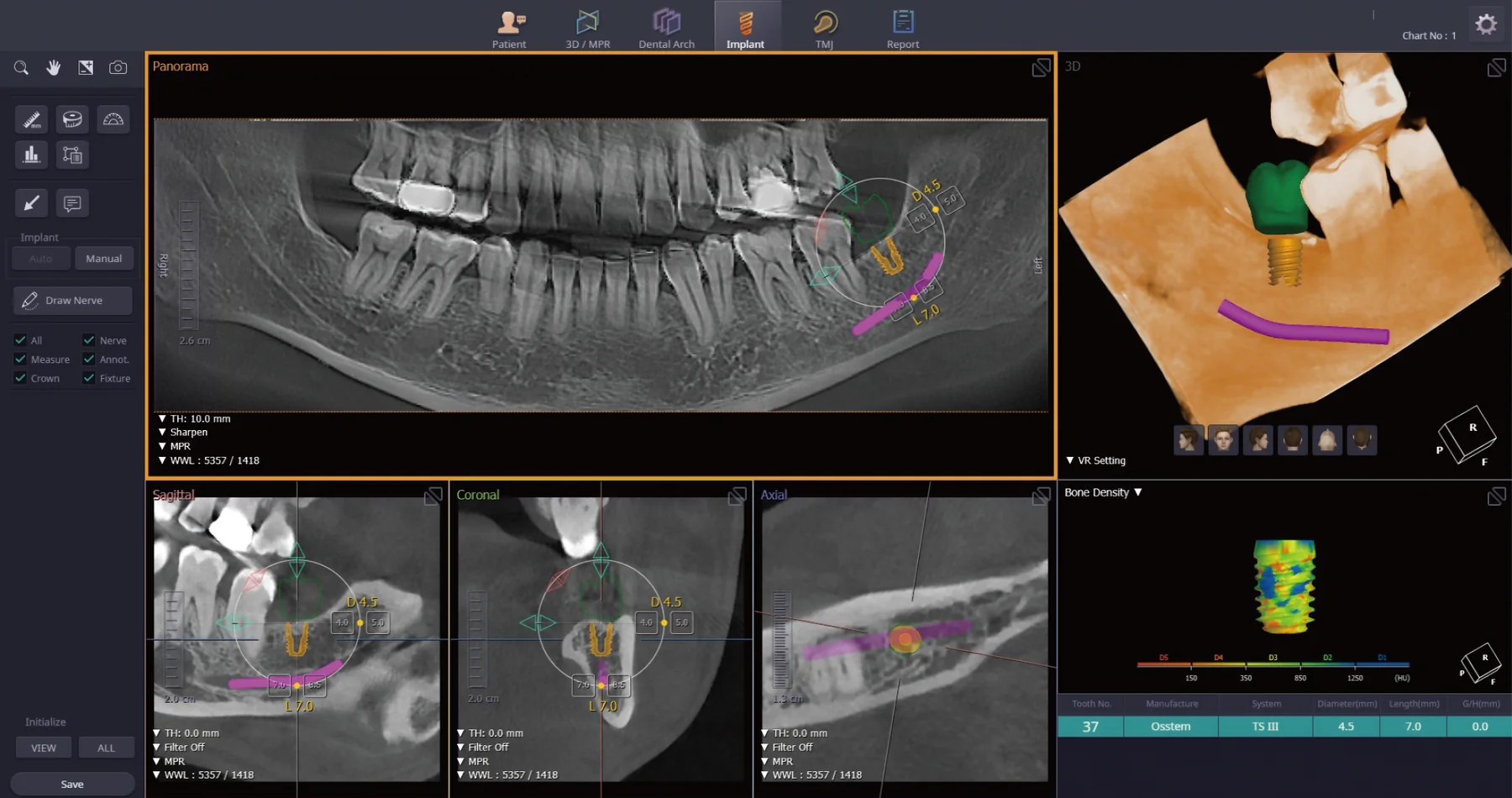 Hiossen T2 Plus AI Implant Planning CBCT - t2-implant-planning.webp