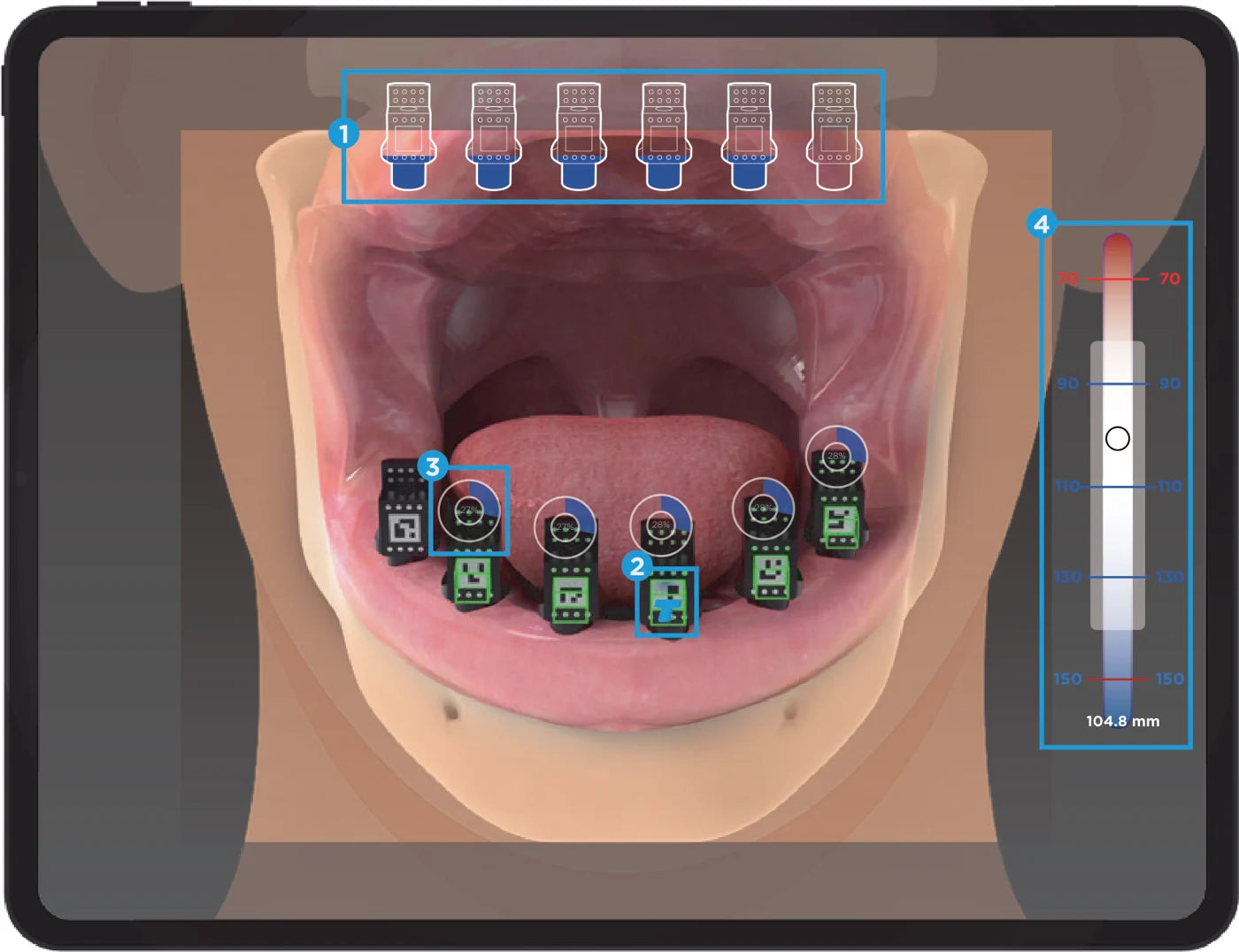T-Marker app detecting markers on a full-arch case